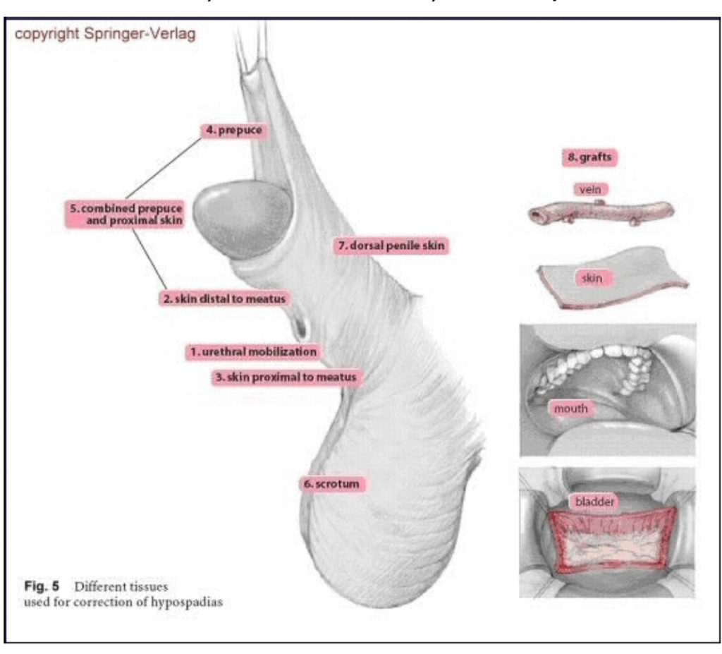 Tissues used for hypospadias correction