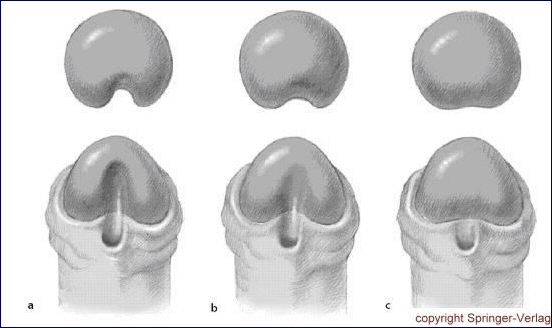 Classification of glans in hypospadias