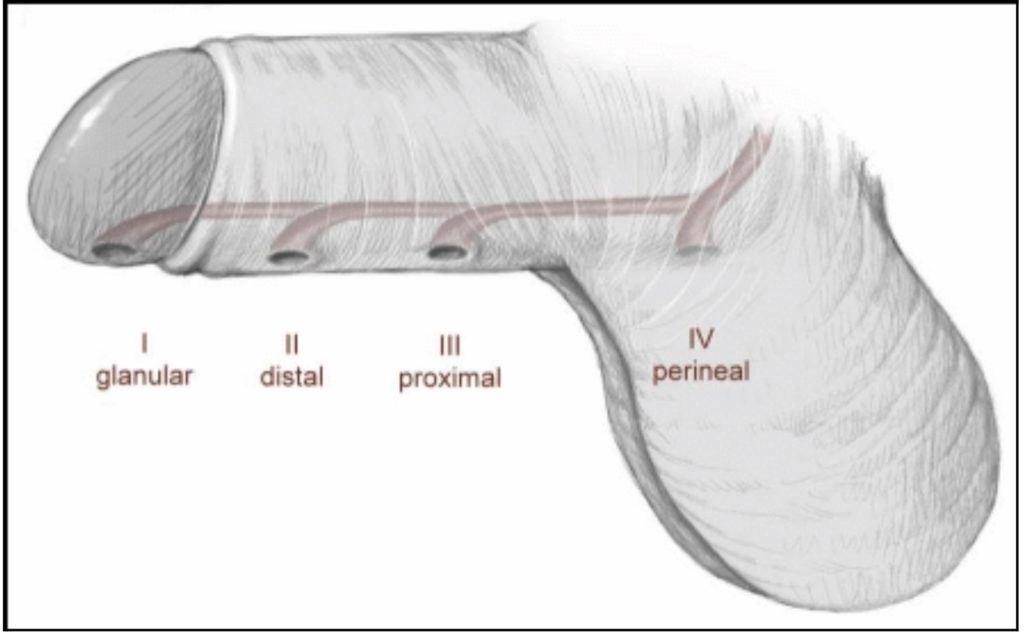 Classification of hypospadias