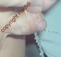 More urine from fistula