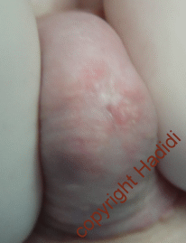 Pin point meatus after TIP