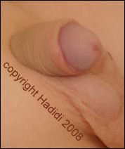 3 months after circumcision after hypospadias repair