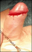 Circumcision, end of operation, 6 months after hypospadias surgery