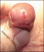Circumcision, 6 months after hypospadias surgery