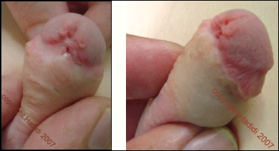 There is not a lot of healthy tissue available for a successful correction