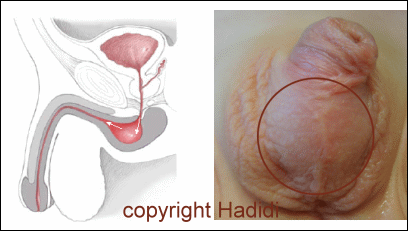 Diverticulum Image