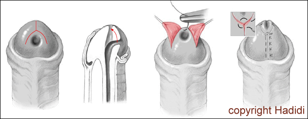 Double-Y-Glanuloplasty Drawing