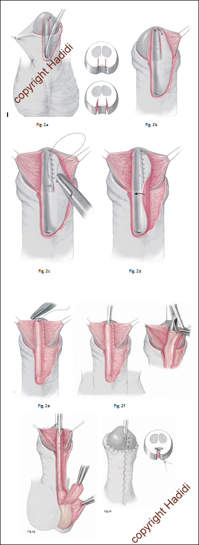 LABO-Technik für proximale Hypospadie