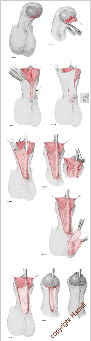 Lateral-based Flap-Technik