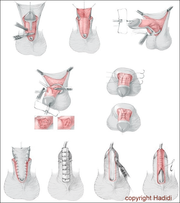 Zweistufige Reparatur Schritte