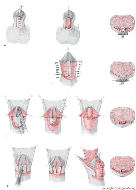 Use of ventral skin for neourethra