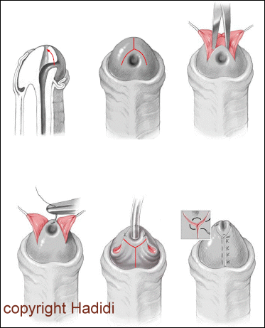 Double Y Glanuloplasty