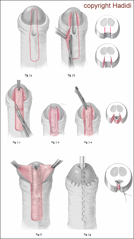 SLAM-Technik für distale Hypospadie