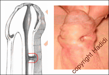 Fistula After Hypospadias Repair