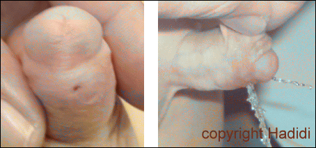 Recurrent Fistula After TIP Repair