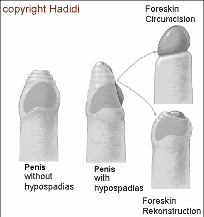 Foreskin Reconstruction