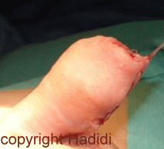 Foreskin Reconstruction, end of operation, after distal hypospadias