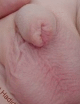 2.5 months after operation