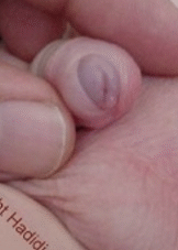 2.5 months after operation