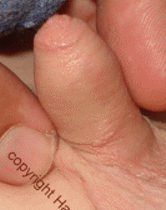 6 months after operation