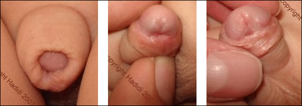 Foreskin Reconstruction During Hypospadias Correction