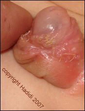 Foreskin Retraction Too Early