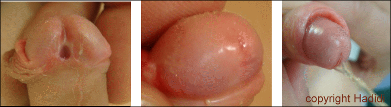 Post-op Glanular Examples