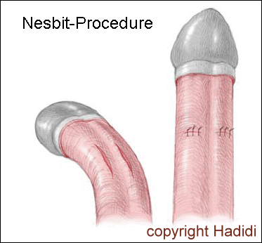 Nesbit Procedure Drawing