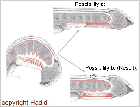 Nesbit Procedure Post-op