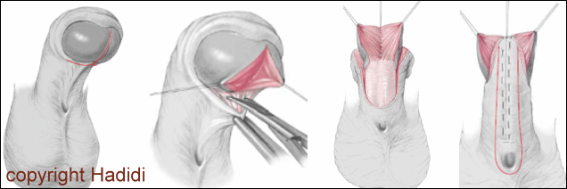 Two-Stage Repair for Perineal Hypospadias