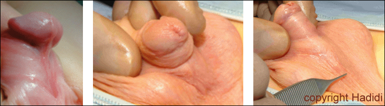 LAB Technique Post-op Results