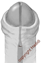Stenosis with narrow new urethra