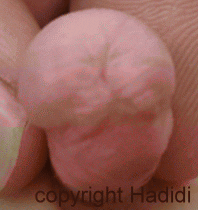 Stenosis and Fistula after TIP